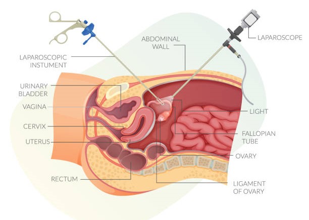 DIAGNOSTIC LAPAROSCOPY